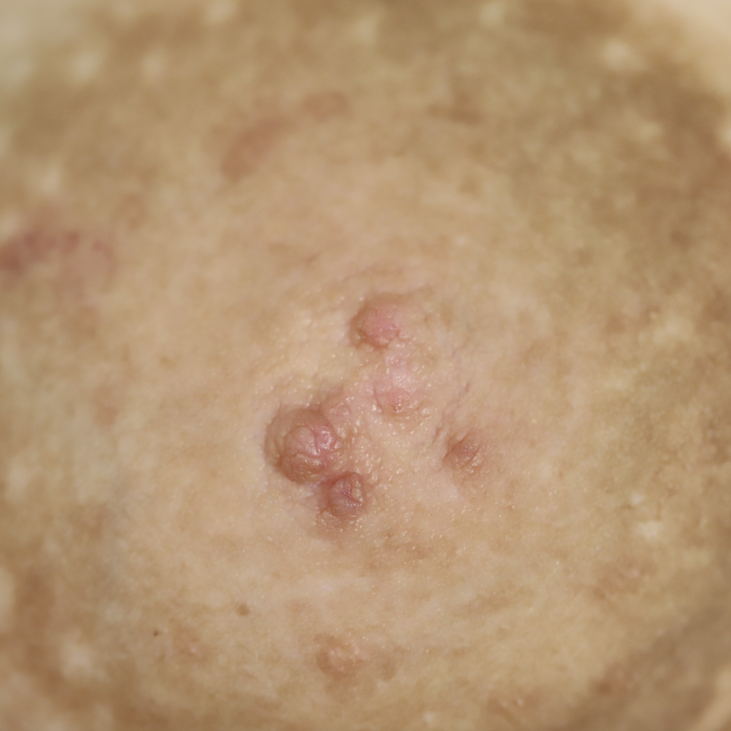 Discontinuous nipple